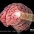 【3D医学动画】脑瘤治疗方法—放疗（中英双字幕+原版英文）
