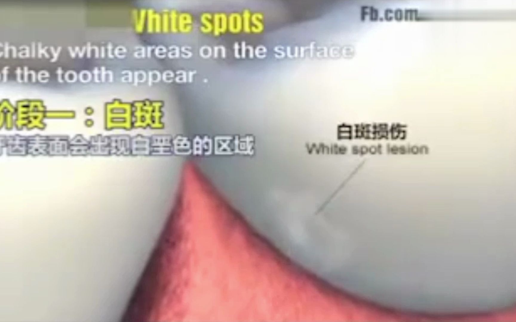 牙齿龋坏的五大阶段，大家可以看着小视频自测