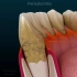 3D动画展示牙周炎变化