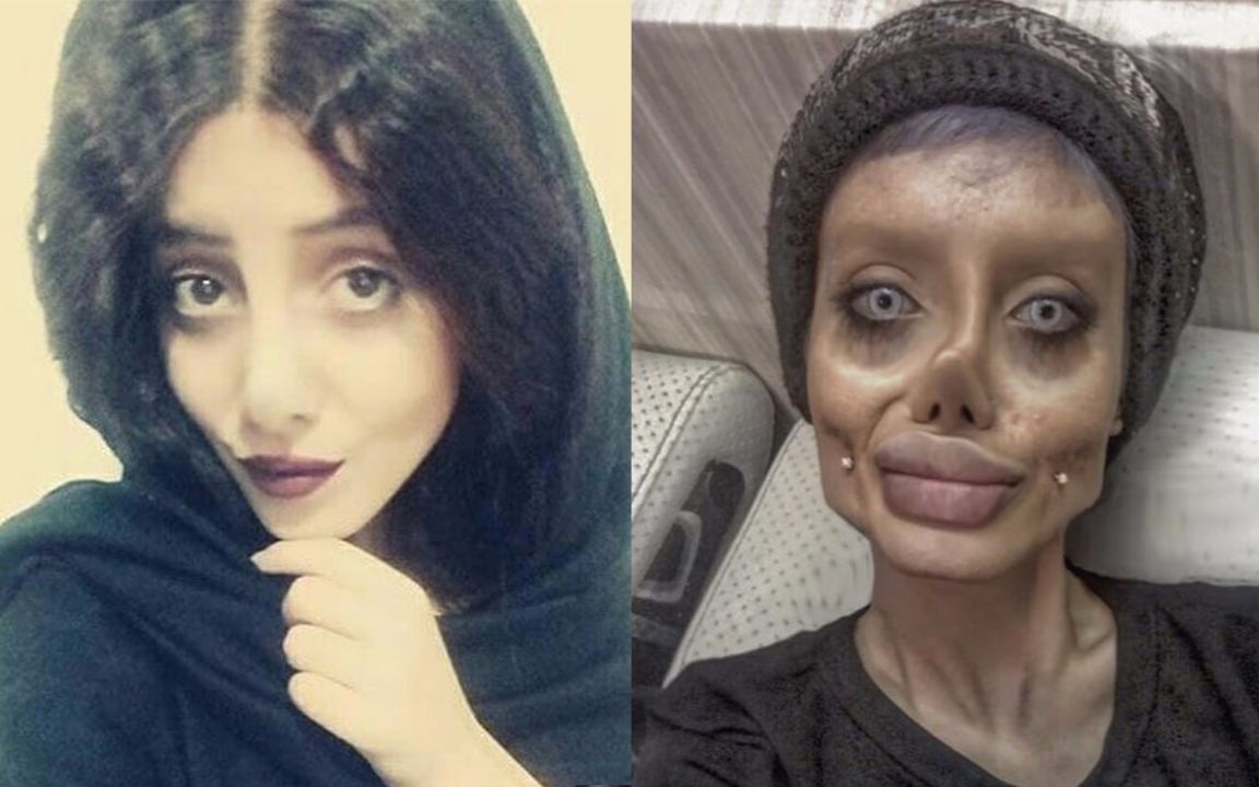 19岁伊朗少女为变成偶像朱莉整容50次 仿佛僵尸新娘