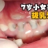 7岁小女孩乳牙烂了，爱挑食乳牙滞留，导致需要拔除