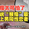 听说“猴痘”最爱盯上男同性恋者