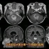 70岁女性，头晕恶心一个月，头颅磁共振发现典型疾病，医生分享