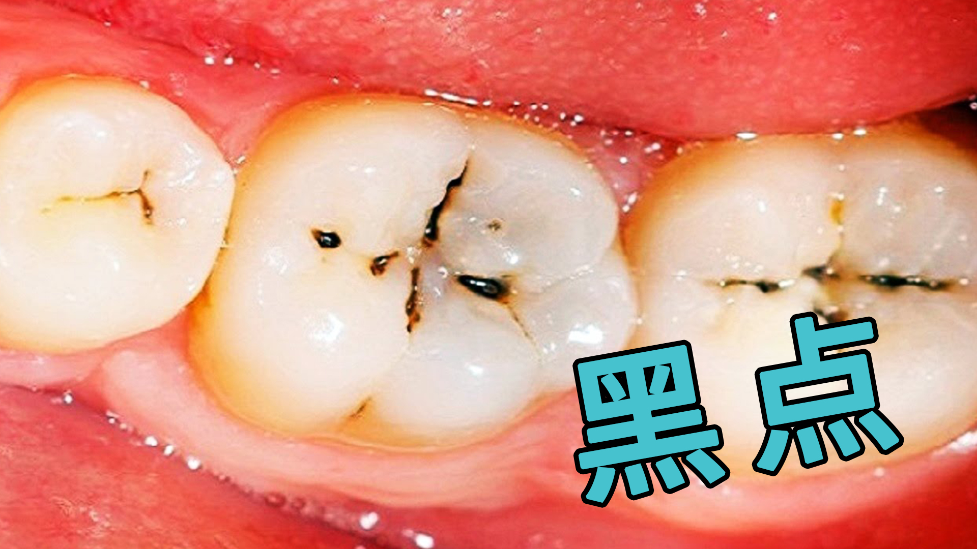 牙齿上常被忽视的小黑点最终危害会有这么大