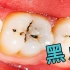 牙齿上常被忽视的小黑点，最终危害会有这么大