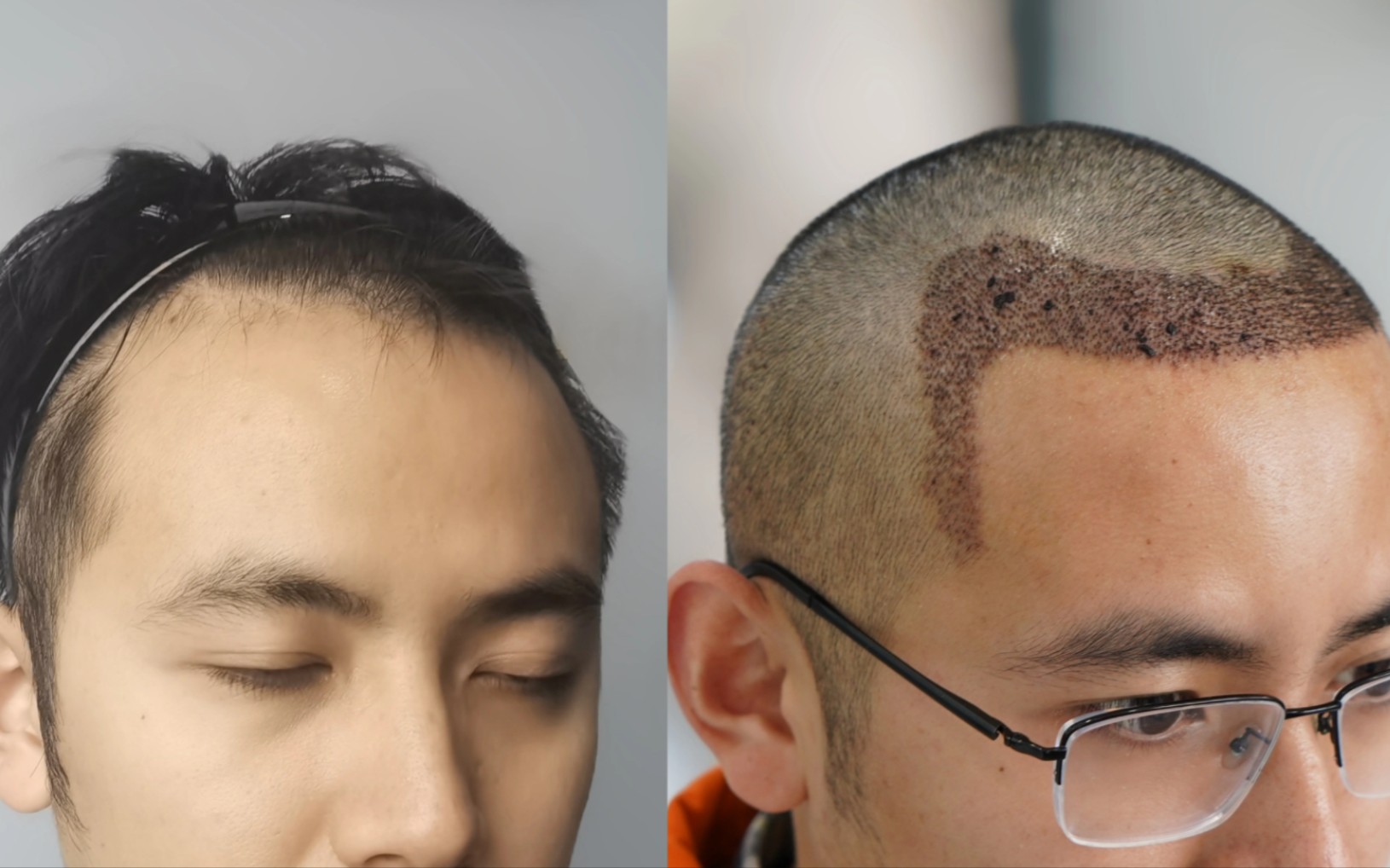 花2万植发改善M型脱发，240天的效果大家觉得怎么样？