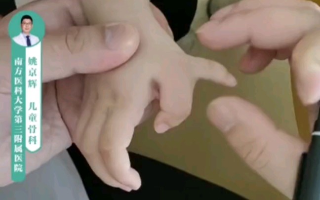 多指宝贝的手指不只是多一个， 而且还明显弯曲，多见于肥厚性骨骺、三节拇指等情况，拍摄X光可以很明确看到多出来的骨骼。
