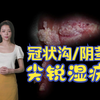 男性冠状沟、阴茎尖锐湿疣症状图片 - 医学科普 |有图有真相