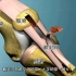 罗纳尔多经历的手术，膝部十字韧带修复手术，3D演示。。