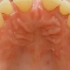 许昌口腔医院/许昌牙齿矫正/牙齿矫正后的效果