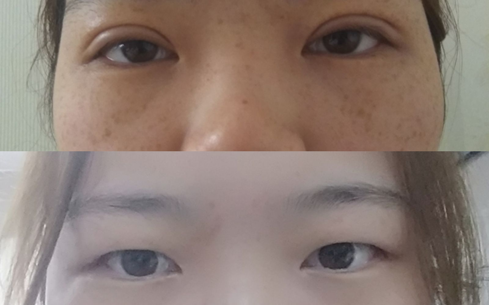 肿眼泡去皮去脂,全切双眼皮手术7天恢复记录