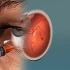 Macular Degeneration - 眼科学黄斑变性3D动画演示