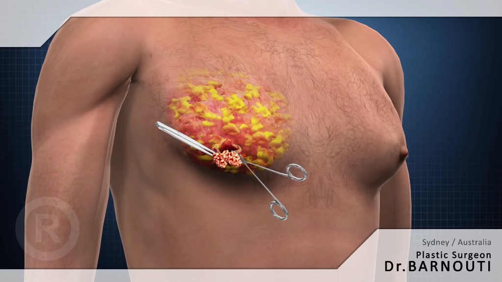 男性乳腺增大，得手术切除，3D演示。。