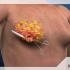 男性乳腺增大，得手术切除，3D演示。。