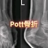 20.Pott骨折—读片系列-骨肌系统