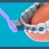 戴牙套的你是如何刷牙的？「大连齿医生口腔修复中心」「大连口腔医院」「大连烤瓷牙价格」「牙齿美白多少钱」「牙齿贴面」「补牙