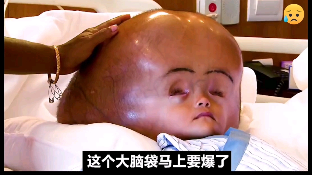 婴儿脑袋重20斤，头围竟达到94厘米！
