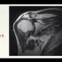 骨关节MRI- 02 异常肩关节 MRI 解读（肩袖损伤）