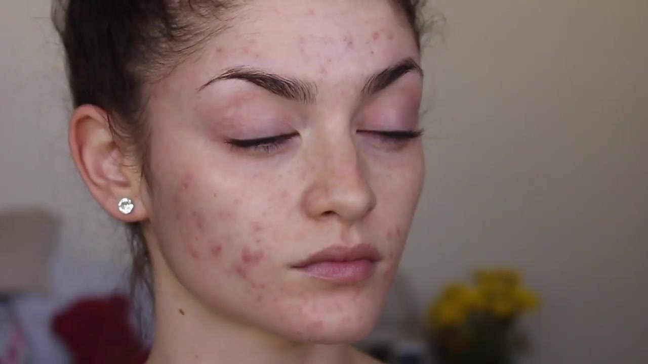【搬运】超强遮瑕力的日常妆容 痘肌瑕疵皮必看 || covering acne
