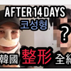 男生去韩国整鼻子？我的韩国鼻整形全纪录+1至2周术后真实后记【JUNHO WONG