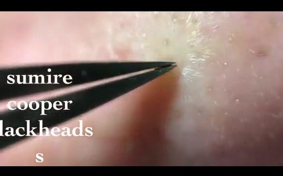 最新挤痘痘视频