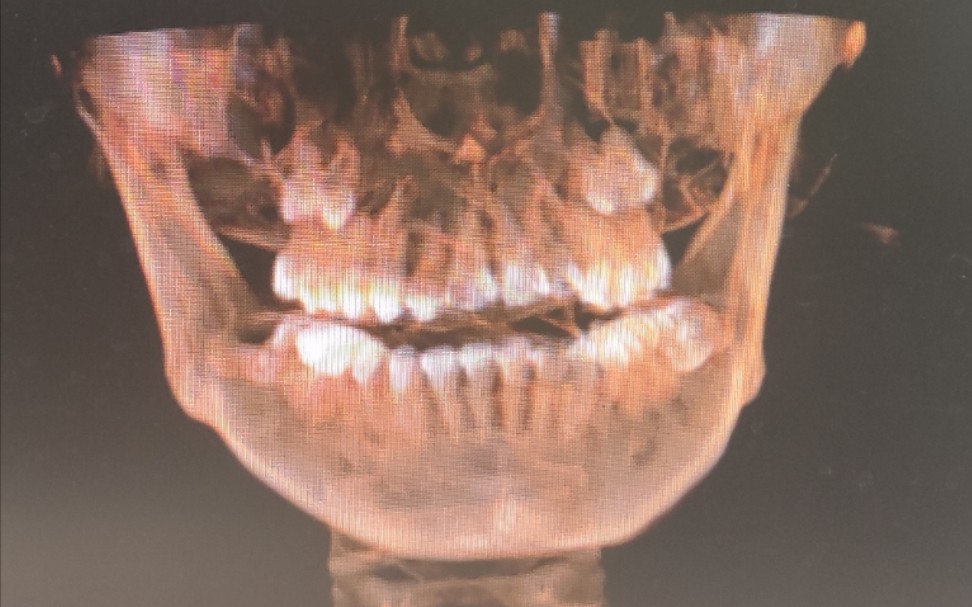 牙齿矫正三年失败后无医生接手