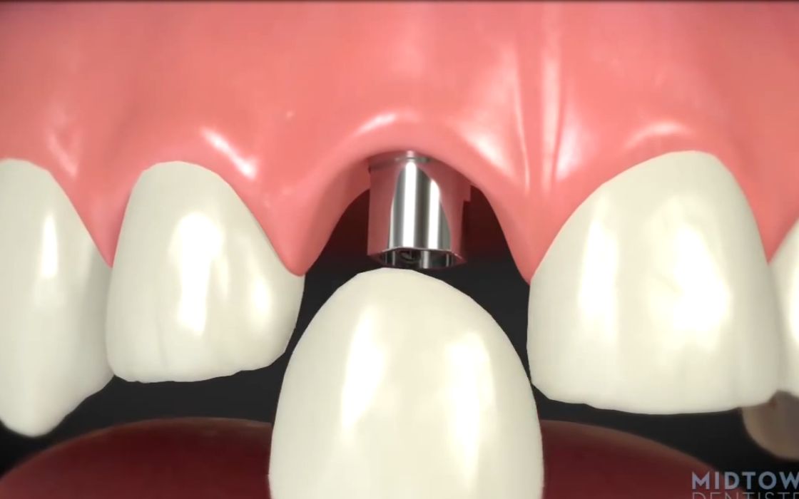 【3d演示】种植牙的优点(原版 字幕版)