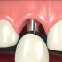 【3D演示】种植牙的优点（原版+字幕版）