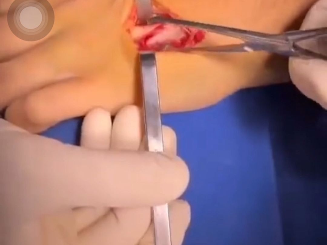 Surgery for broken bones in the hand