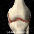 【医学3D】：膝关节滑膜炎