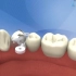 树脂补牙的全过程，蛀牙就是这么补起来的