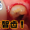 拔智齿，这样的智齿必须拔除，前面牙齿都没了