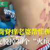 男子秋衣脱掉30个“火疖子”，老婆抓背脊吓一跳！#白癜风# #白斑