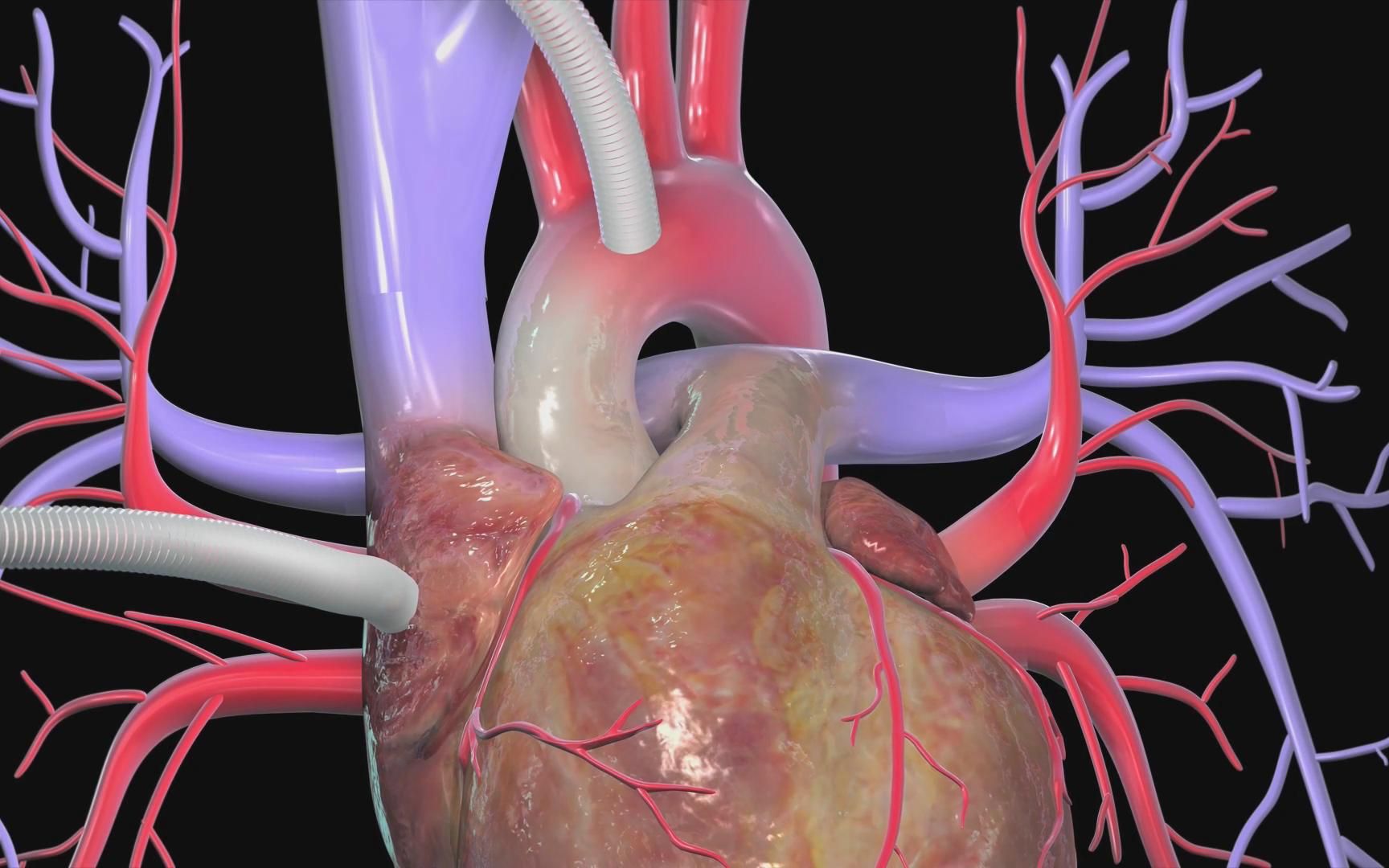 科普3d超清演示三种心脏搭桥手术终于看明白了乐喷网心脏病大通盛道乐