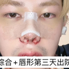 鼻综合+唇形第三天终于出院了，后续继续分享