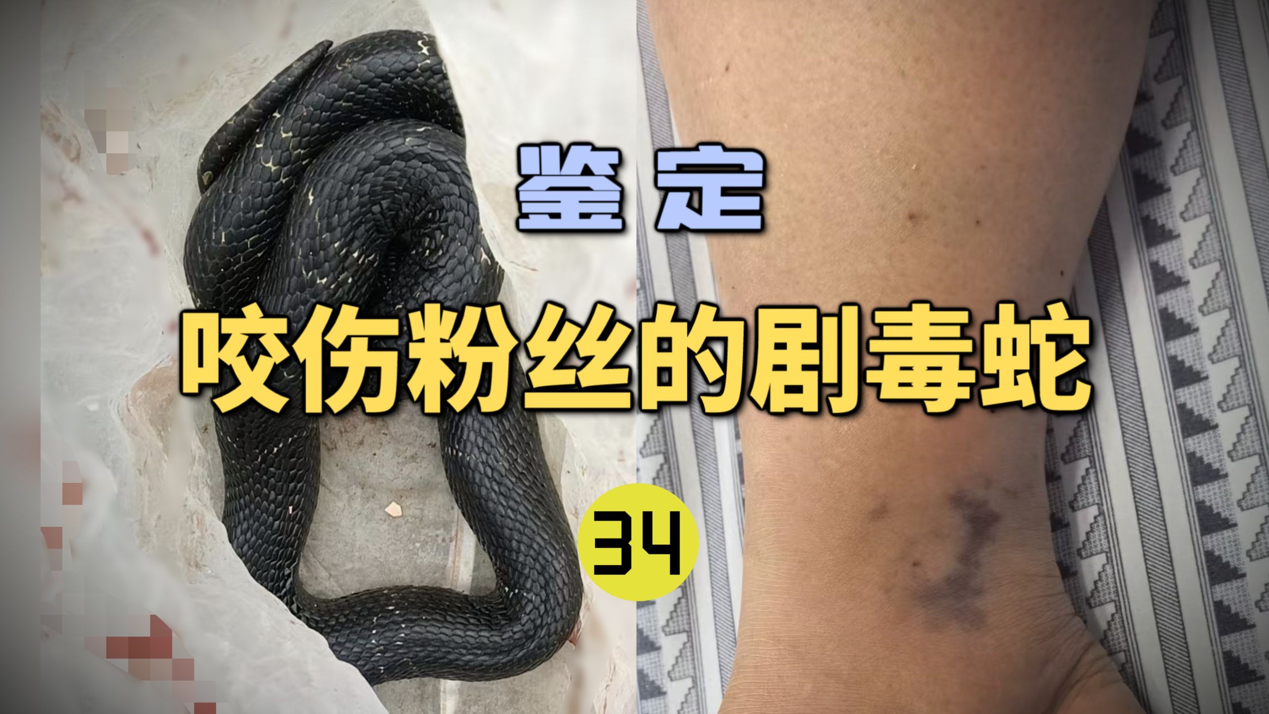 鉴定咬伤粉丝的毒蛇(34)女子被竹叶青咬伤后凝血崩溃！还有人说竹叶青毒不死人吗？