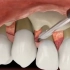 仙游口腔：牙龈萎缩牙根外露应该怎么治疗？