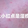 痒死了。。身上的小红点究竟是什么