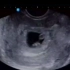 孕6周，第一次B超，确定宫内孕，有胎心啦！#传好孕