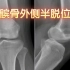 4.髌骨外侧半脱位—读片系列-骨肌系统-膝关节