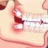 横着长的智齿不拔，可能会导致龅牙！