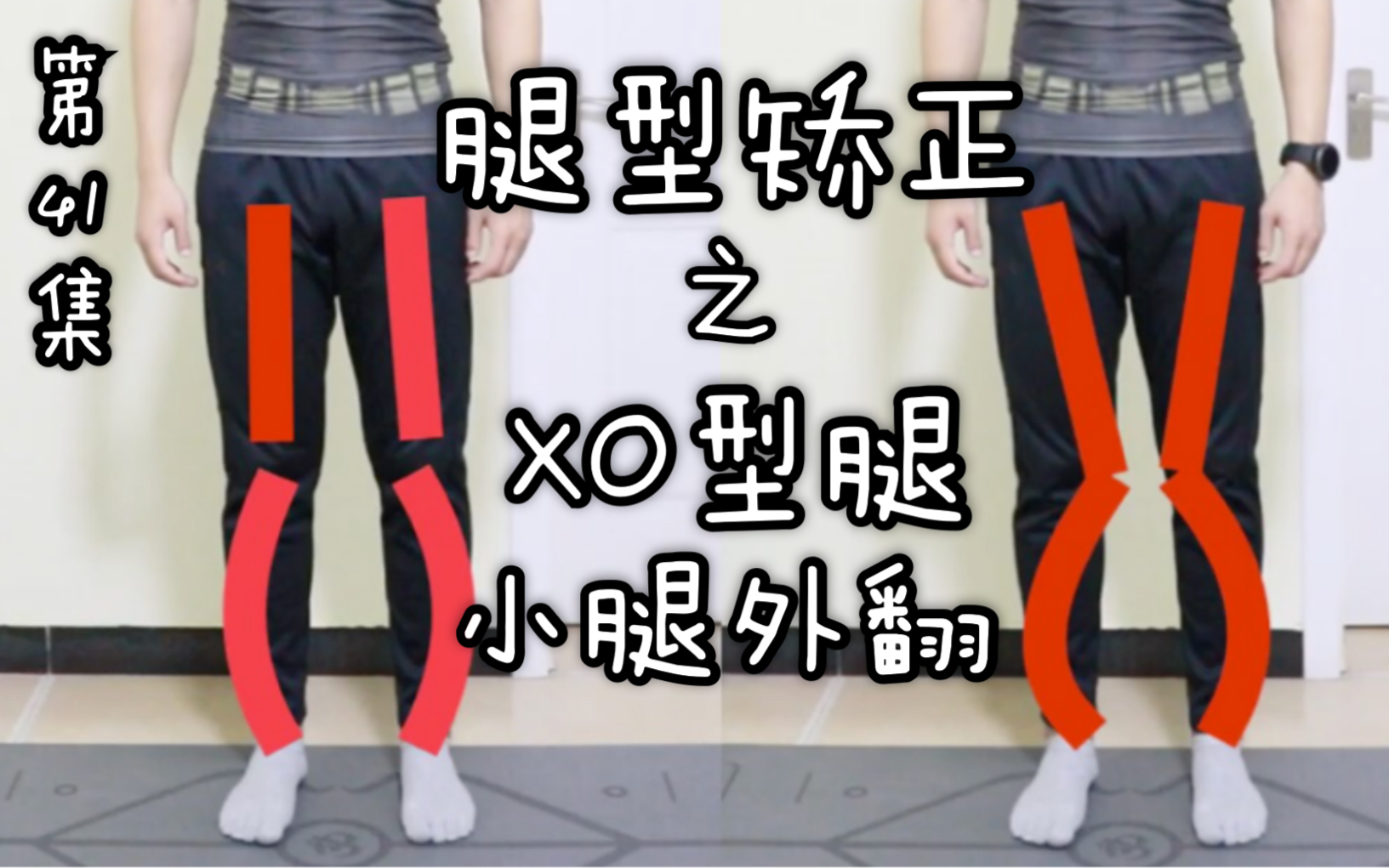 【XO型腿】小腿外翻矫正！快来看科学的方法！3招快速瘦小腿，改善腿型
