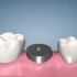 种植牙的全流程，你见过吗？