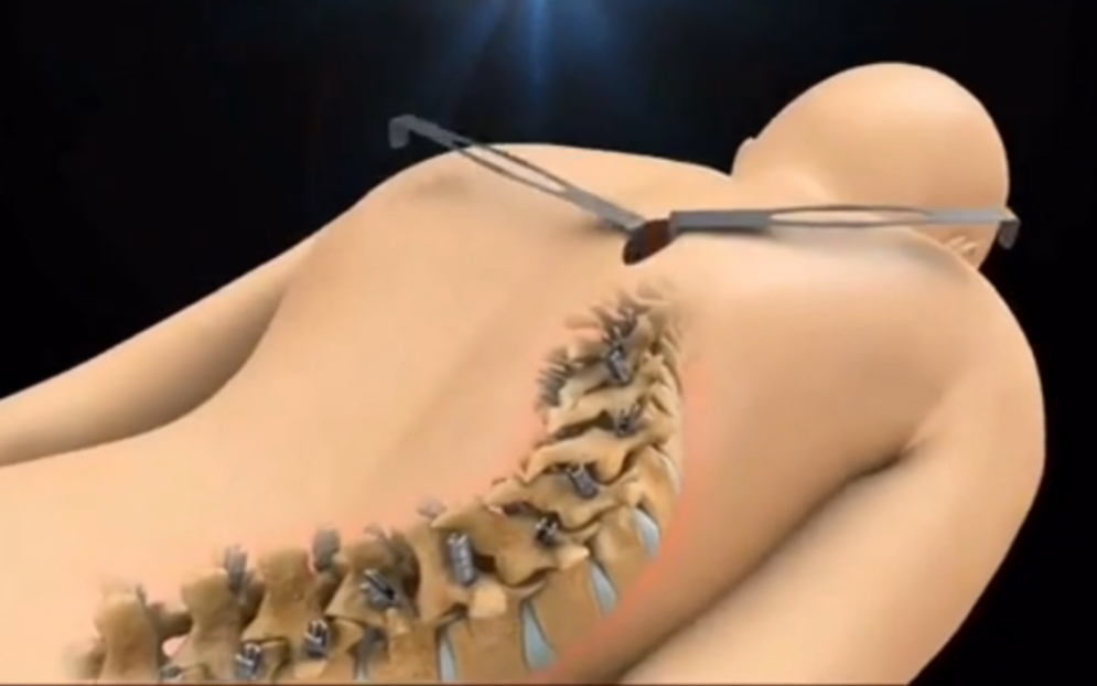 3D视频演示：脊柱侧弯修复术