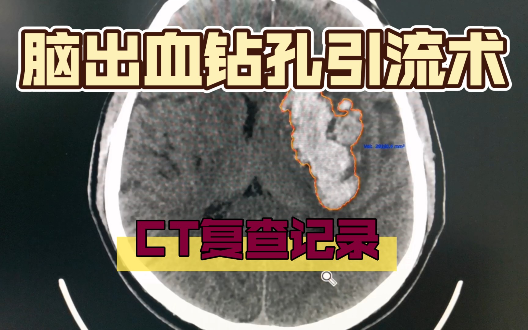 脑出血钻孔引流术后的CT复查记录
