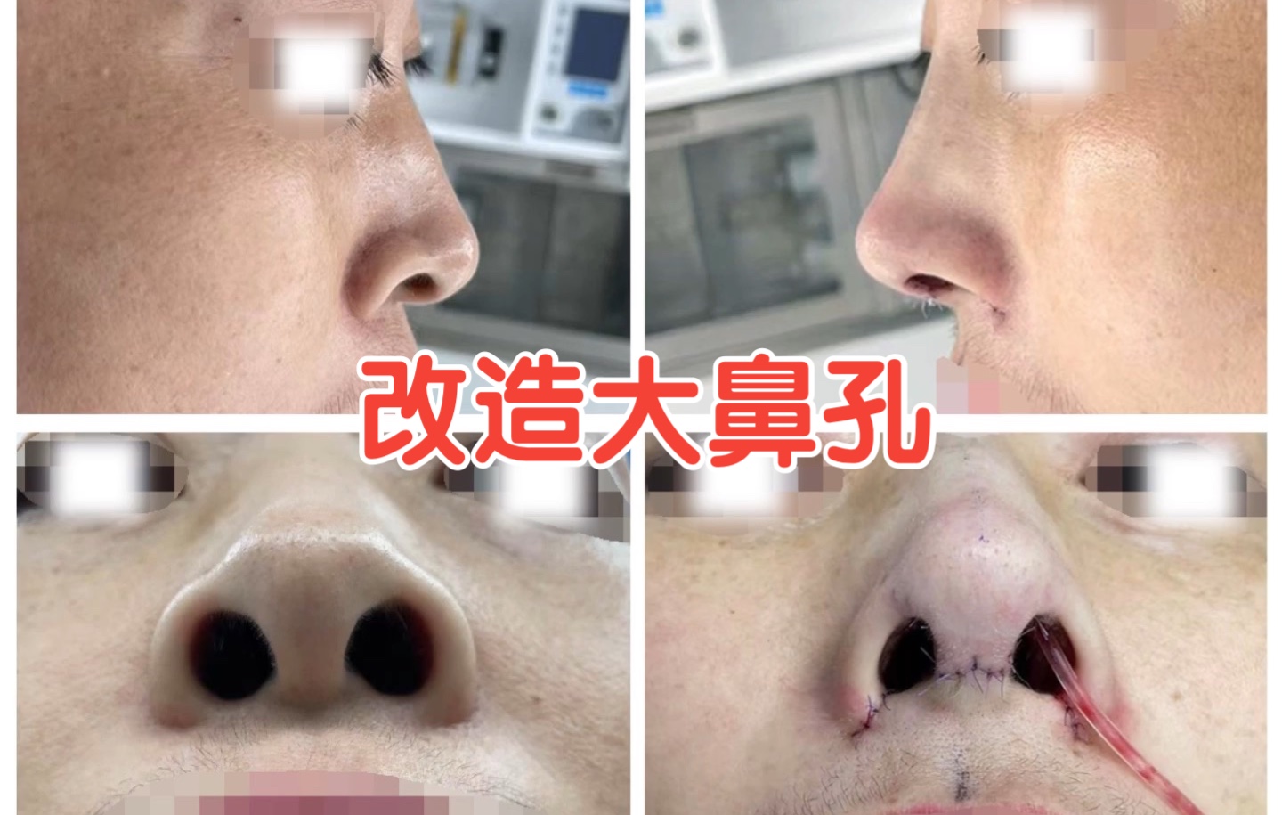 大鼻孔改善修复，看看术后的效果吧