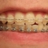 每天一张照片，记录牙齿矫正461天的时间流逝