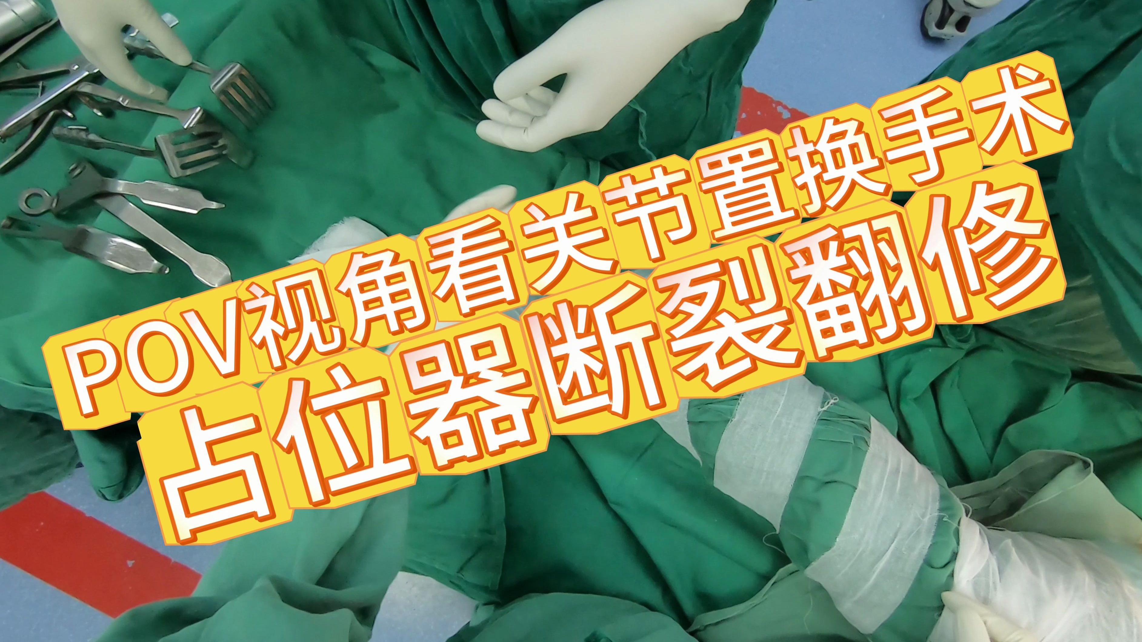 【感染系列】复杂髋关节外科手术——占位器断裂翻修