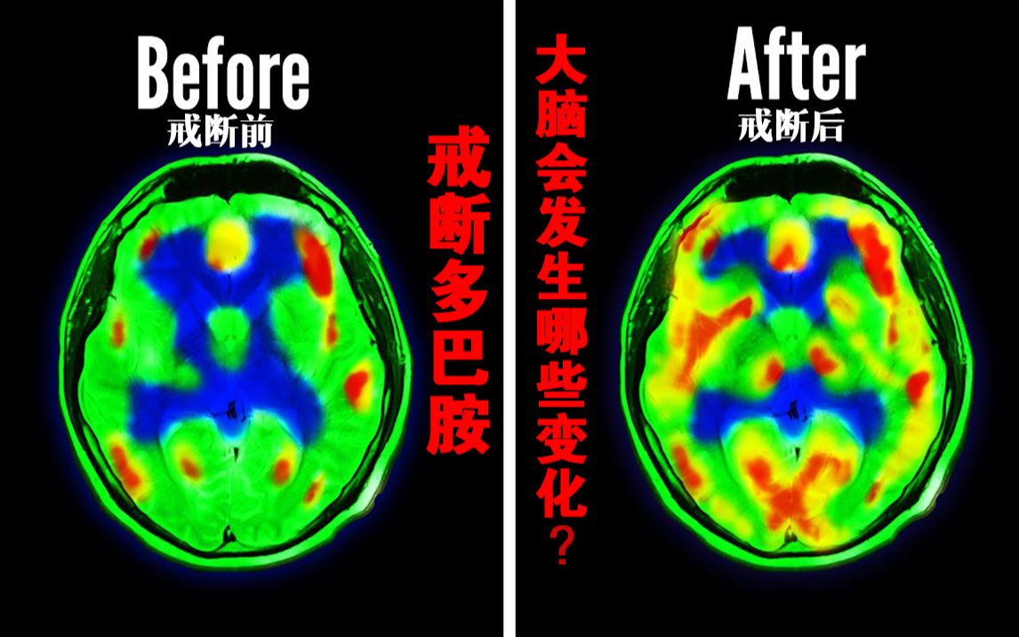 “戒断”多巴胺挑战——7天后，大脑会发生什么变化？