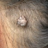 头皮上的小肉瘤要不要切掉？皮内痣会癌变吗？